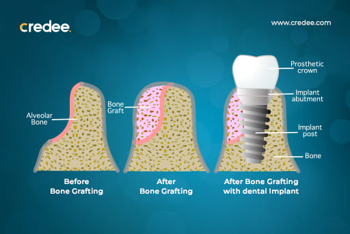 Dental Bone Graft Before And After