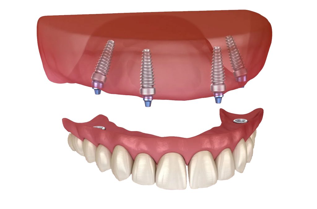 implant retained dentures