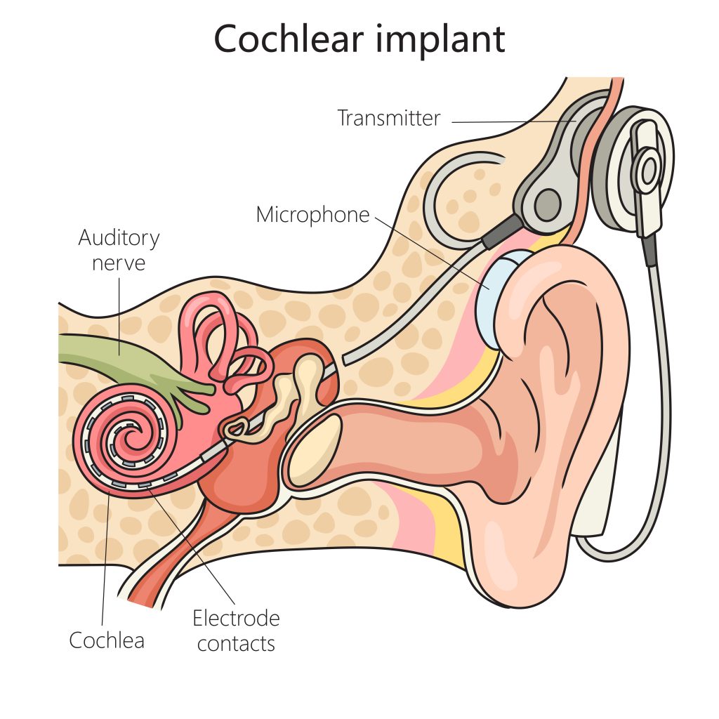 Cochlear Implants Cost