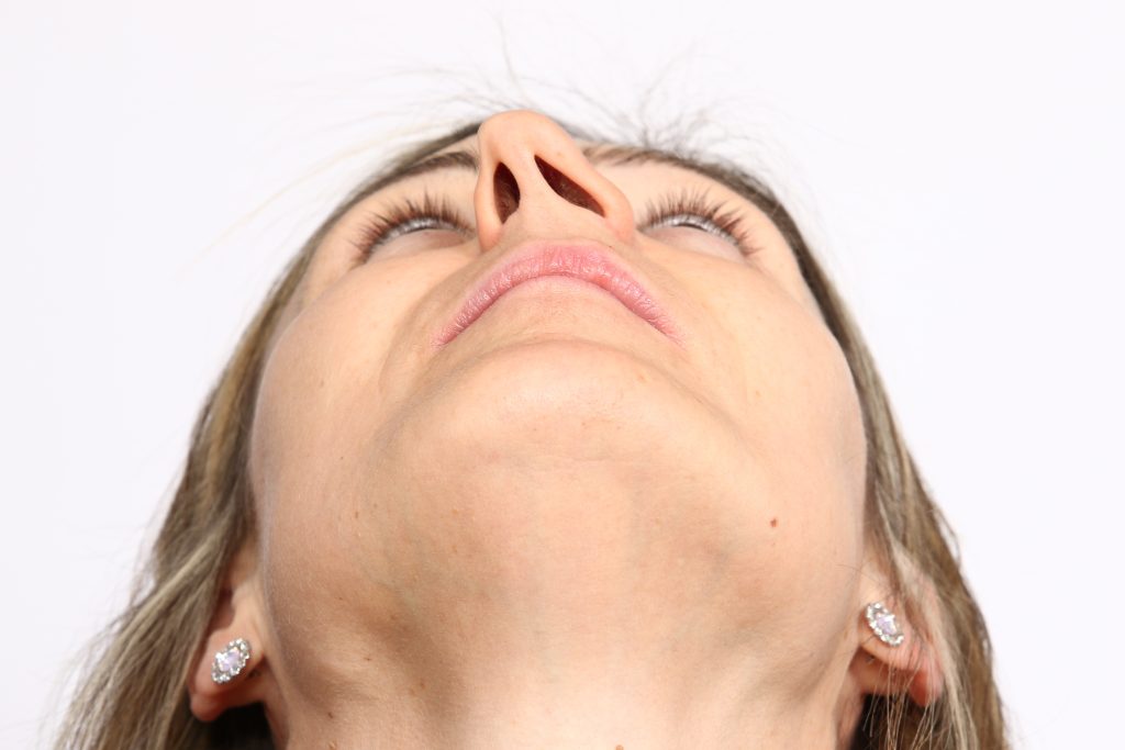 Deviated Septum Nose